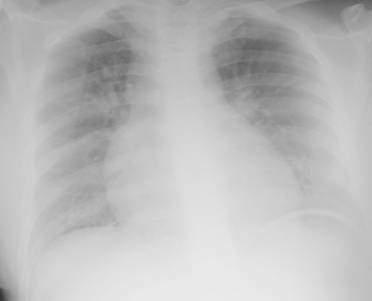 radiographie de poumon