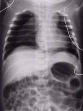 Cours - Pneumologie - Le pneumothorax | Infirmiers.com