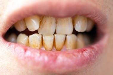 Tabagisme et santé dentaire