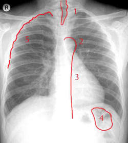 Cours - Pneumologie - Aide à la lecture d'une radiographie de ...